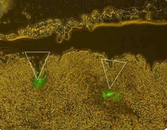 Fluorescence image of human cadaver skin after a CLOPAM patch: the drug, in green, sits at the tips of the needle tracks below the skin surface