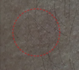 Skin at the patch site after 2 hours of wear
