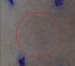 Skin at the patch site after 8 hours of wear